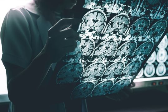 Na Eli Lilly, uma nova esperança contra o Alzheimer