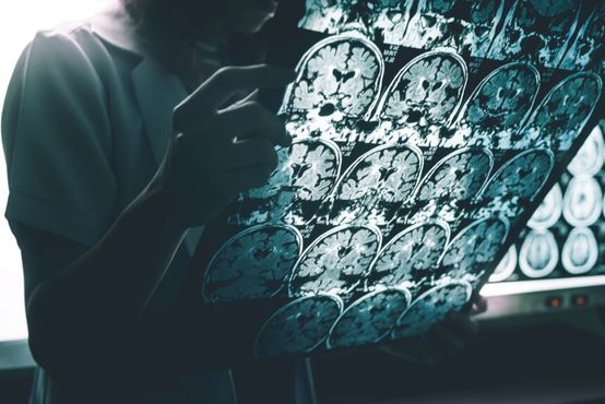 Na Eli Lilly, uma nova esperança contra o Alzheimer