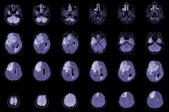 ‘Pelos filhos dos outros’.  Buscando a cura para o câncer cerebral infantil