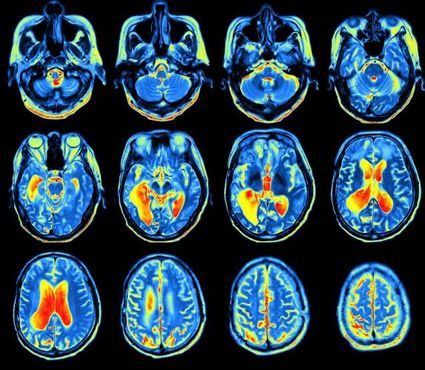 Na luta contra o Alzheimer, um sopro de esperança