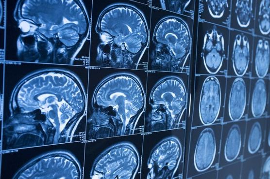 A OccamzRazor está usando computação de ponta para curar o Mal de Parkinson