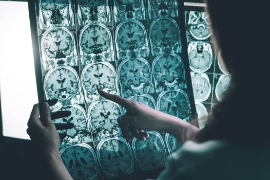 Alzheimer: o maior avanço até agora